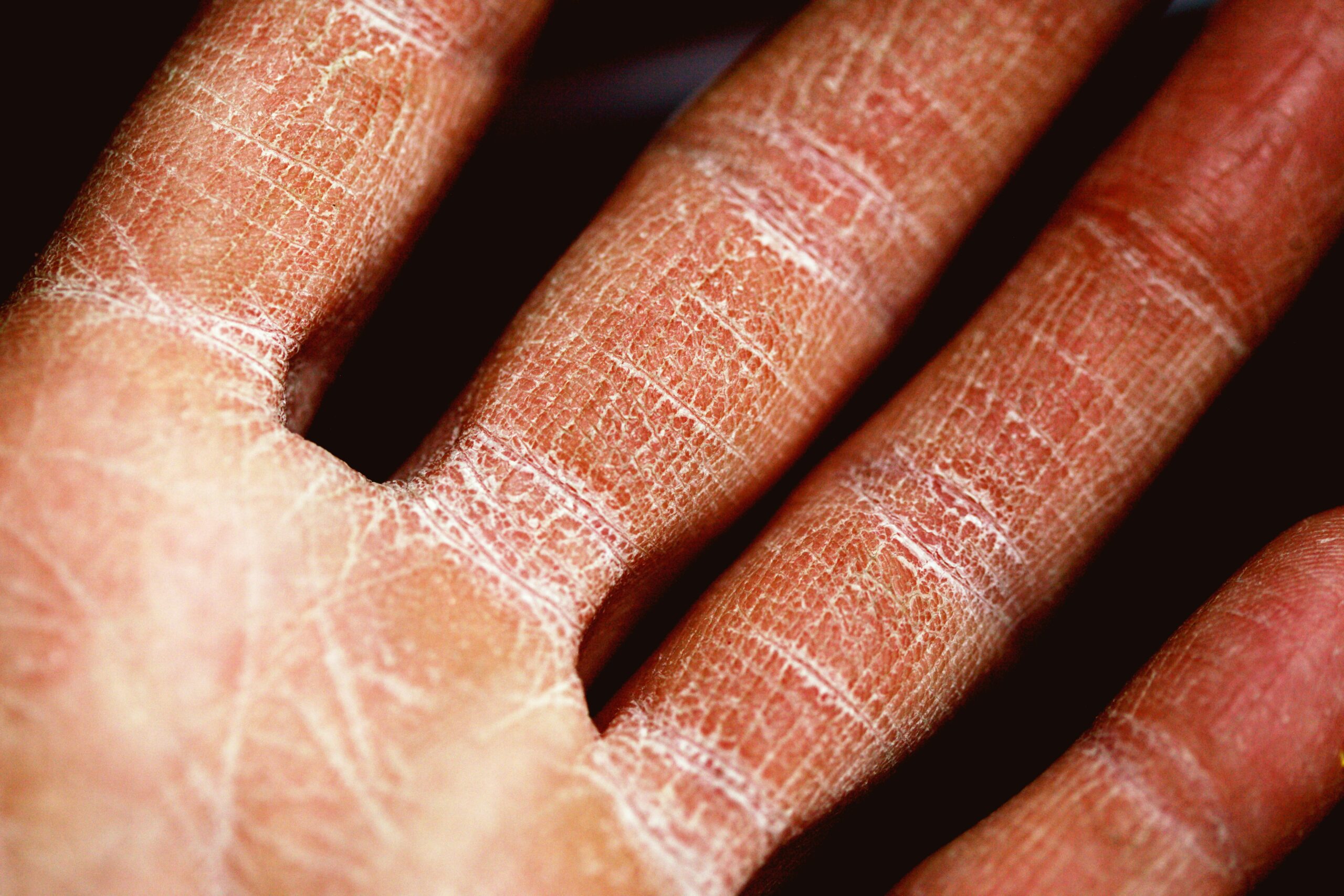 Foods to Avoid With Angioedema featuring common dietary triggers that may contribute to swelling and allergic flare-ups.