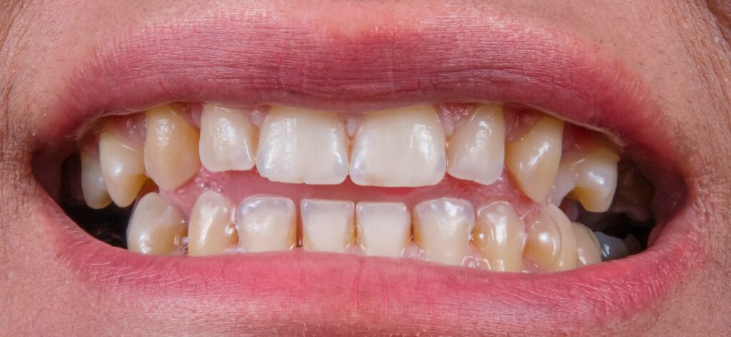 why is my gum swollen around one tooth in the back, Person pointing to swollen gum near a back molar during a dental checkup.