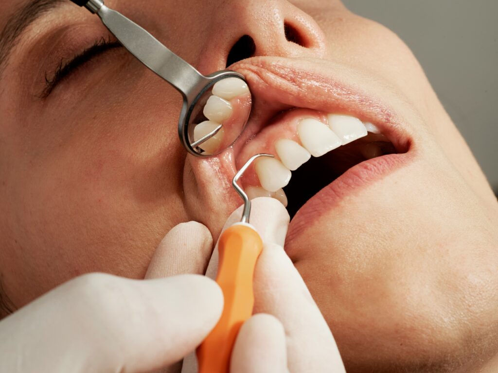 Wisdom tooth hole never closed years later and signs to watch for