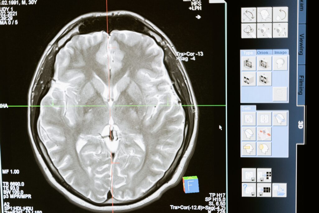 Can you develop dyslexia later in life and common causes of reading problems