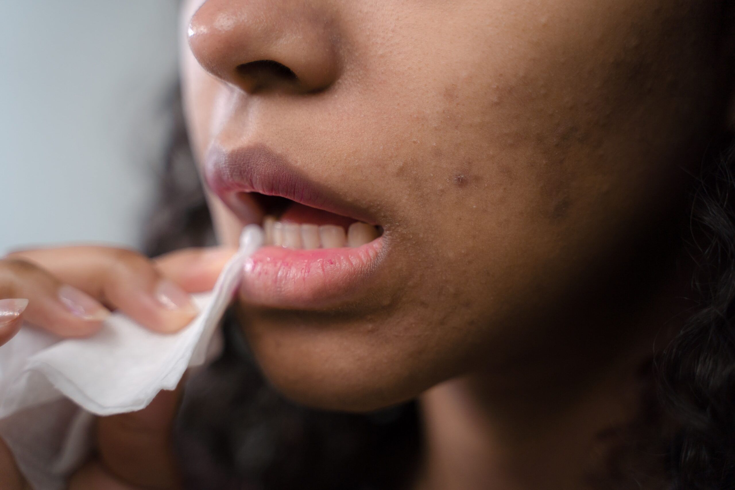 Why is the inside of my mouth peeling and common causes
