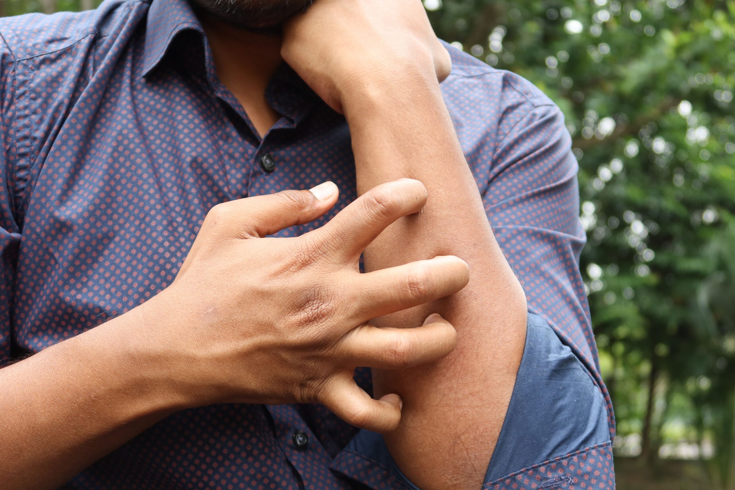 Why Does My Sunburn Itch So Bad? Causes and Relief Solutions